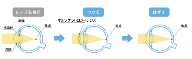 オルソケラトロジー